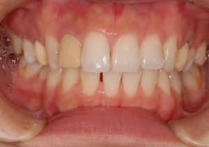 p2_whitening_allceramic