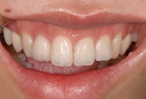 p3_whitening_allceramic